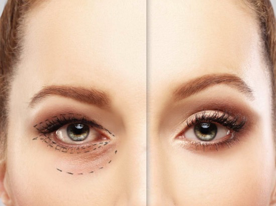 Blefaroplastia